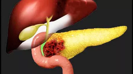 4 boli ale pancreasului