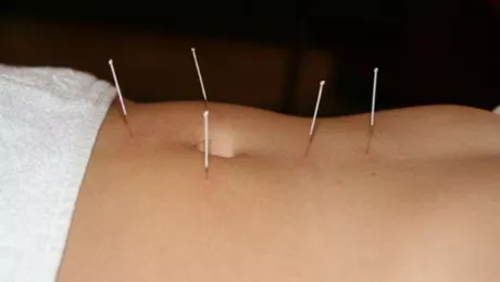 Acupunctura o tehnica care trateaza anxietatea sindromul premenstrual obezitatea menopauza infertilitatea osteoporoza