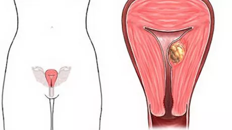 Cum se face vindecarea fibromului fara operatie