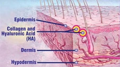 Ce este acidul hialuronic