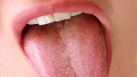 Cele mai frecvente afectiunii ale limbii si gurii