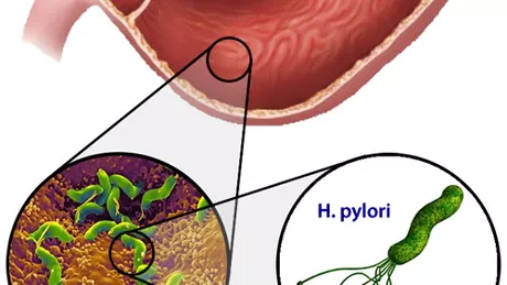 Scapa de helicobacter pylori si ulcer cu doua retete naturale 
