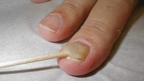 7 modificari patologice la nivelul unghiilor