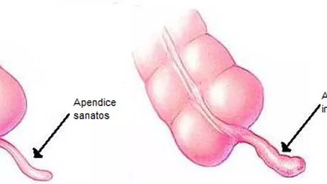 Regimul alimentar dupa operatia de apendicita