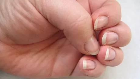 Semne de pe unghie care anunta cancerul