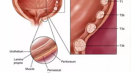 Cancerul de vezica urinara. Factori de risc diagnostic si modalitati de tratament