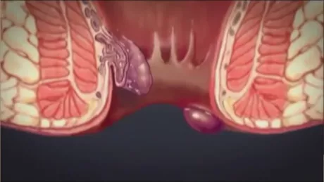 Cum tratam hemoroizii care apar in sarcina