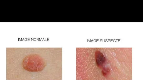 Cancerul de piele 4 imagini care trebuie sa va alerteze 
