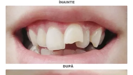 Ce trebuie sa faci imediat daca ti se rupe un dinte