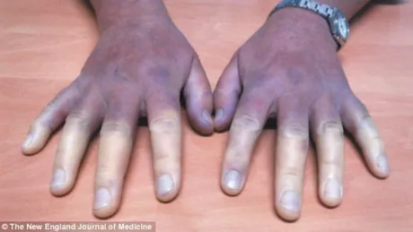 Sindromul Raynaud boala care iti invineteste mainile la frig. Care sunt cauzele cum se manifesta boala si ce trebuie sa faci