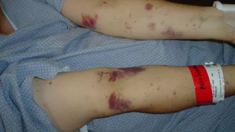 Purpura trombocitopenica imuna. Semne de alarma care impun de urgenta consultul medical