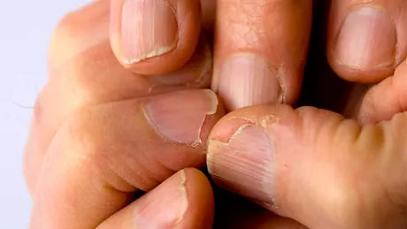 Ai unghiile exfoliate sau mainile aspre si crapate Ce boli tradeaza aspectul mainilor
