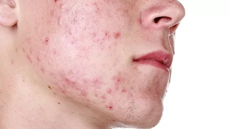  Particularitatile fiecarui tip de acnee