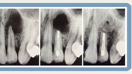 Granulomul dentar infectie periculoasa la varful radacinii de cele mai multe ori fara simptome