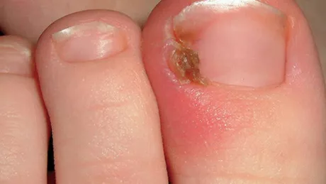 Ce este o unghie incarnata - simptome si tratament