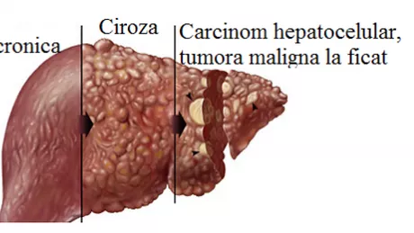 Regimul alimentar indicat pentru bolnavii de hepatita C
