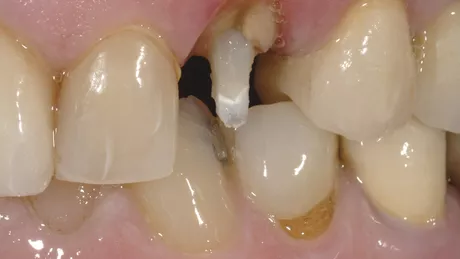Ce presupune reconstituirea dentara cu pivot din fibra de sticla