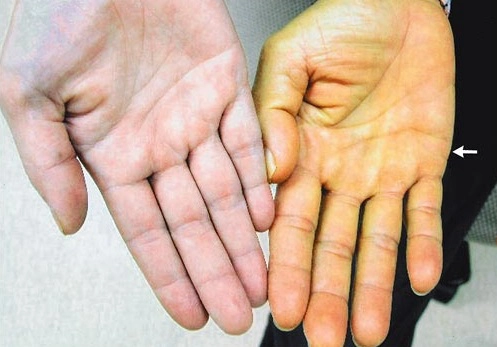 imagine doua maini care prezinta diferenta dintre o persoana sanatoasa si una cu icter