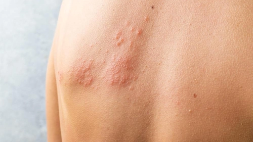 Cum identifici alergiile de la căldură? 5 poze care spun tot!