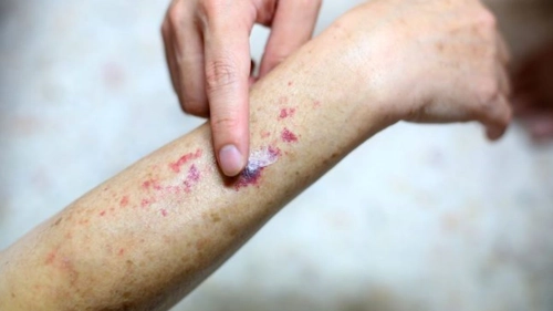 Purpura fulminans, o afecțiune medicală severă și rară! Iată la ce simptome trebuie să fii atent!