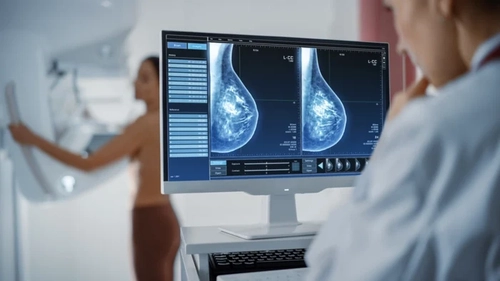 Descoperire revoluționară împotriva cancerului de sân! Un nou medicament reduce la jumătate riscul de progresie sau deces