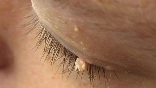 Există tratament pentru virusul HPV? Iată cum să previi infectarea!