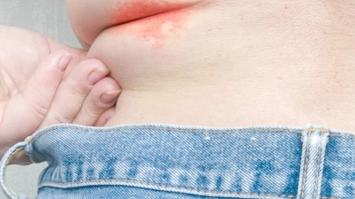 Intertrigo, o afecțiune ușoară, dar cu complicații serioase! Iată cum se poate preveni!