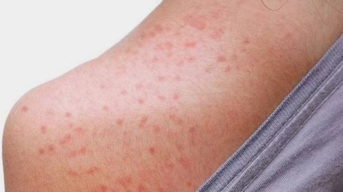 Miliaria, erupția provocată de căldură. Cum recunoști iritația și ce măsuri să iei pentru a o preveni
