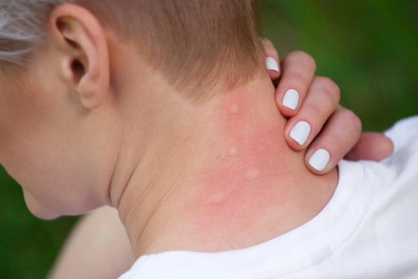 pișcături de țânțari pe piele
