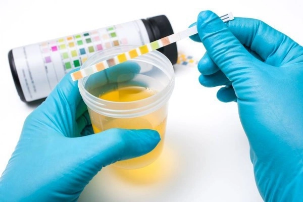 verificarea culorii urinii