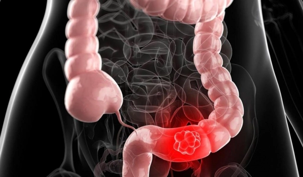 grafica simptome colon iritabil