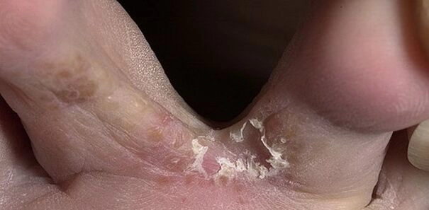 ciupercă între degetele de la picioare