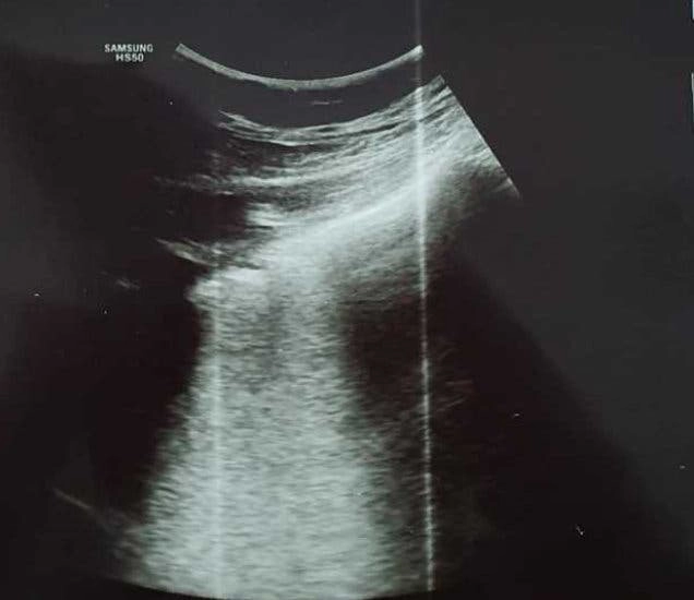 ecografie pulmonara la o femeie bolnava de COVID-19