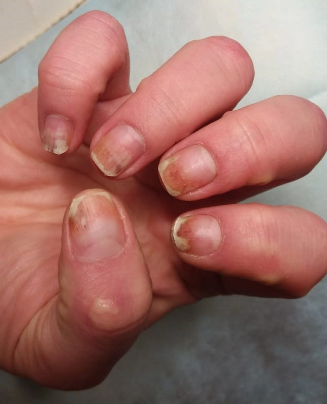 mucegai pe unghia unei persoane