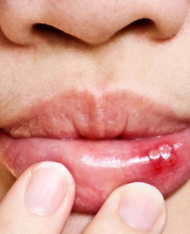 buzele unei persoane afectate de candida bucala