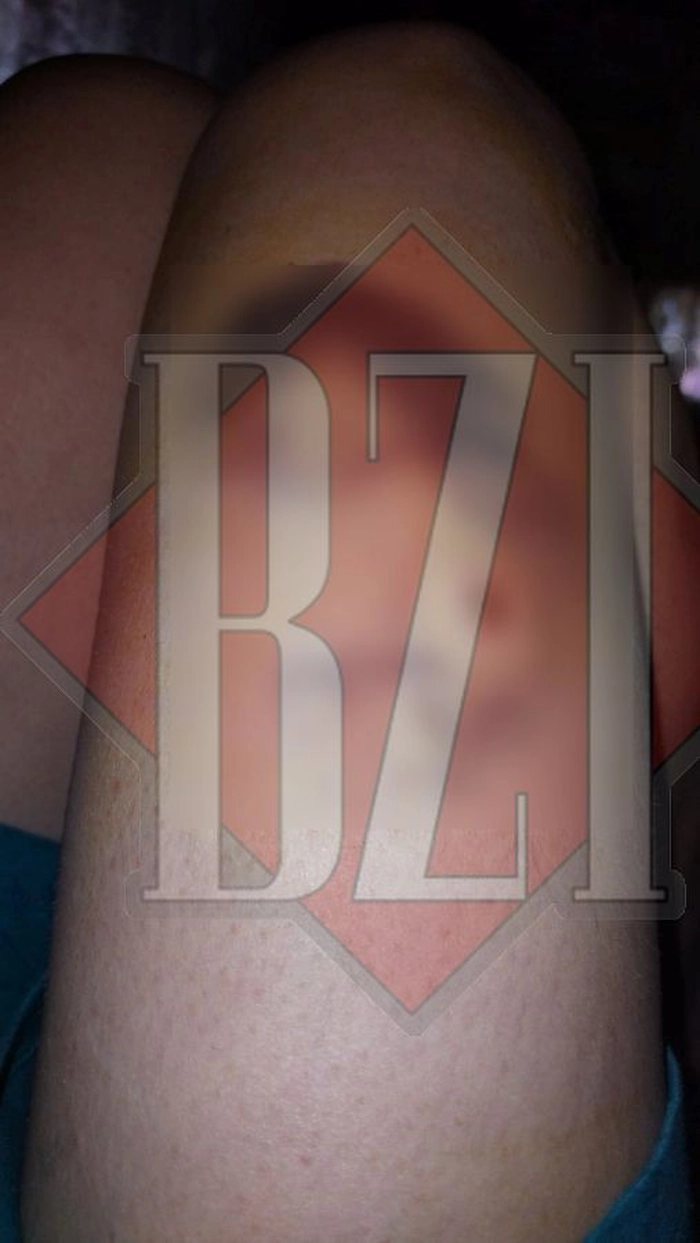 o poză cu piciorul femeii mușcate