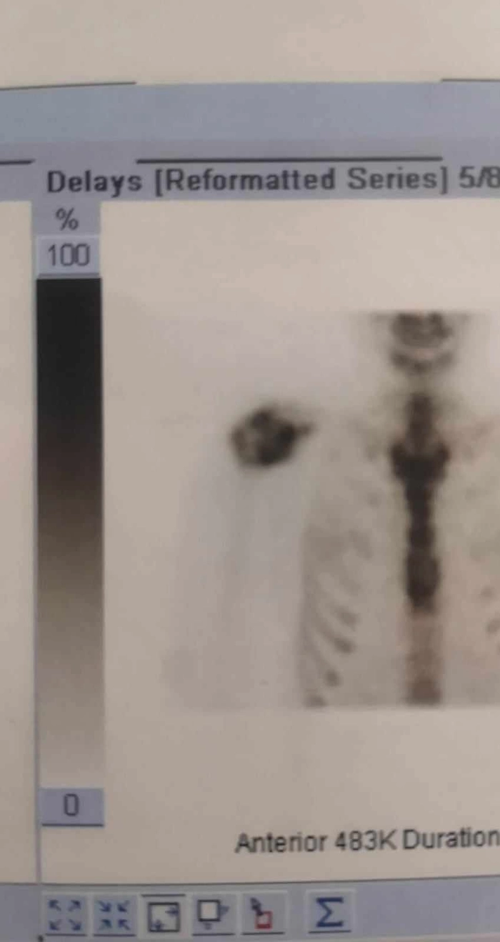 poză cu umărul afectat de cancer