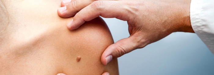 medic care examineaza pielea bolnava de papiloame a unei persoane