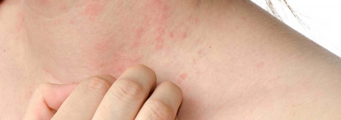persoana care are eruptii cutanate pe gat provocate de urticarie