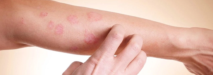 persoana care sufera de mancarimi din cauza eczemelor