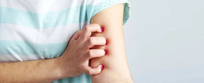 femeie care sufera de mancarimi pe mana