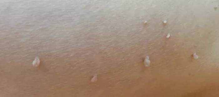 persoana bolnava de papiloame