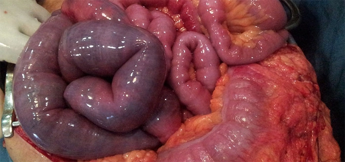 infarct mezenteric