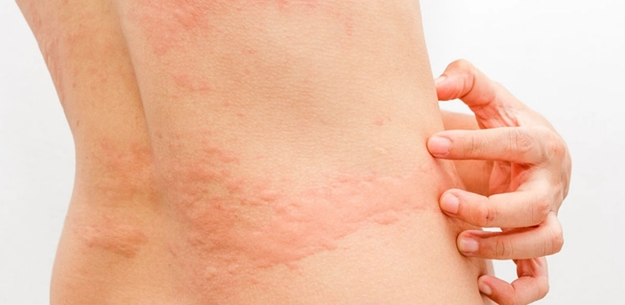 persoana care are bube aparute in urma unei toxiinfectii alimentare