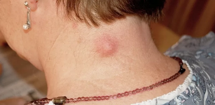 ganglion inflamat la ceafa unei persoane