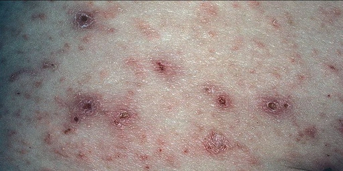 persoana care sufera de scabie