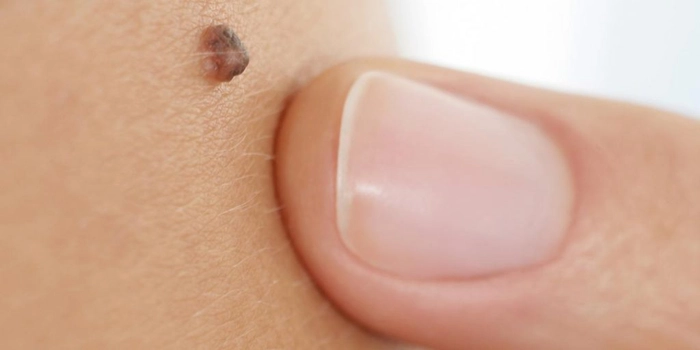 persoana care indica cu degetul spre neagul de pe piele