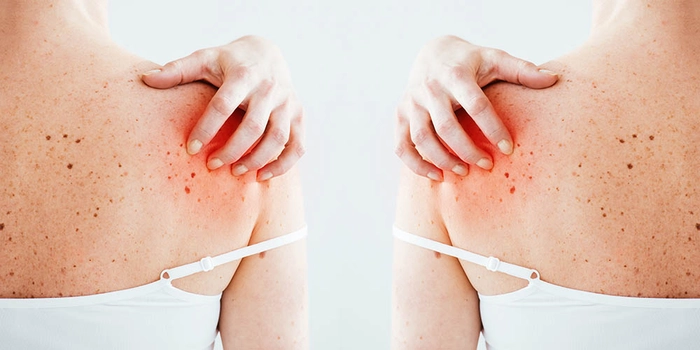 colaj persoana care sufera de zona zoster