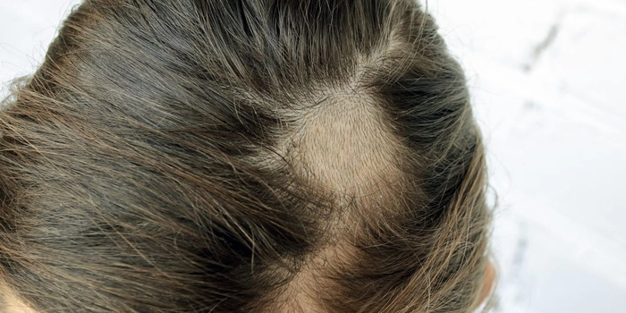 persoana care sufera de ciuperca scalpului
