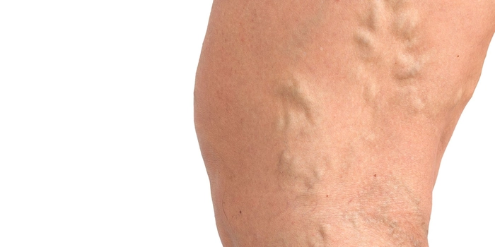 piciorul unei persoane care sufera de trombofilie ereditara